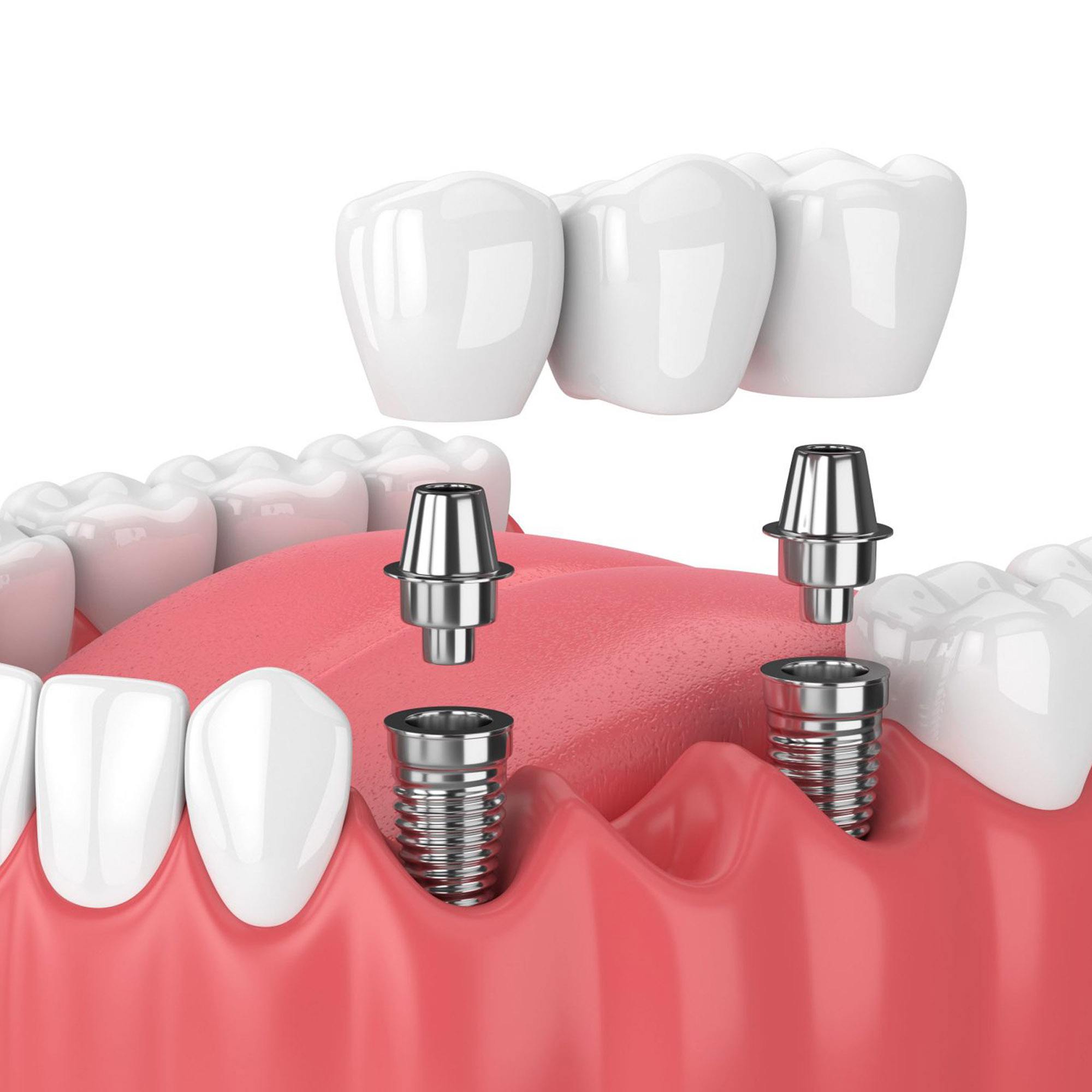 CẤY GHÉP IMPLANT